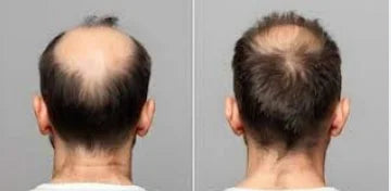 EELHOE  Hair Loss Shampoo & Batana Conditioner Set Strengthening Density Repair Frizz Control Treatment Thinning Damaged Frizzy